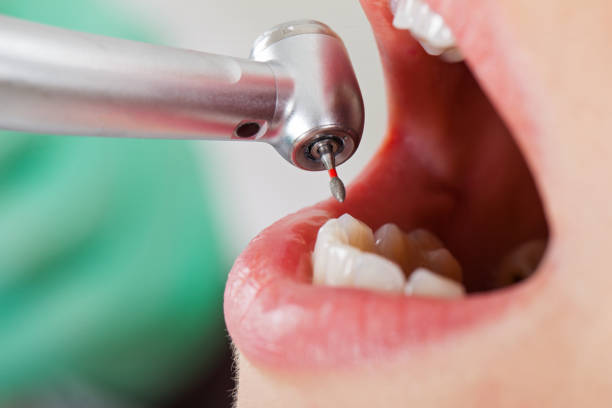 Best Emergency Root Canal Treatment in Magalia, CA
